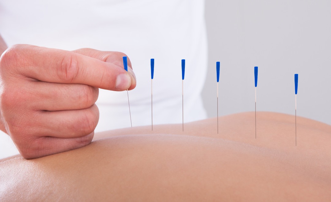 acupuncture